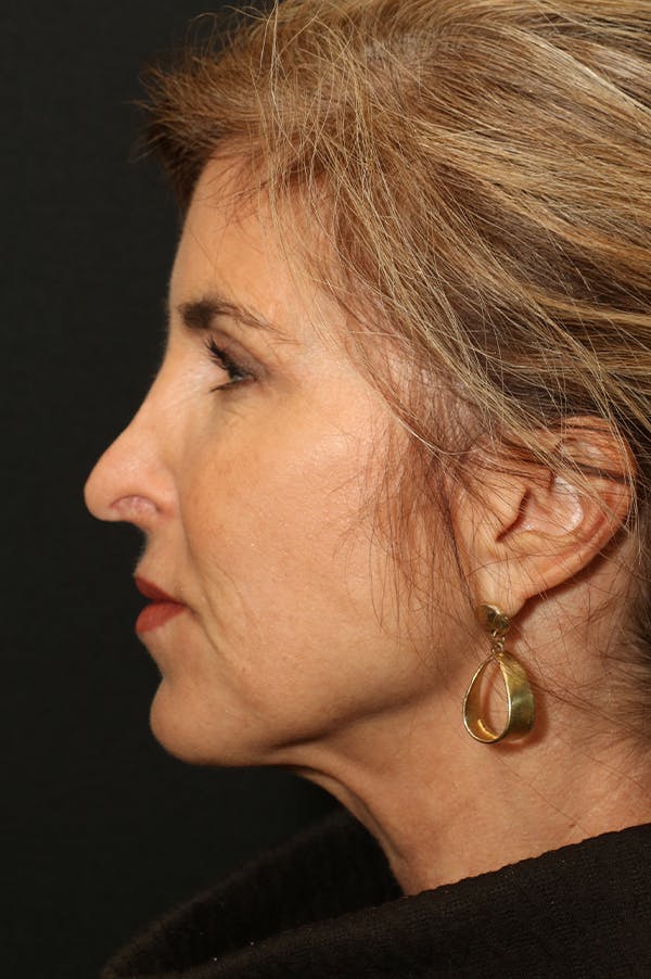 Facelift Before & After Gallery - Patient 24311071 - Image 3
