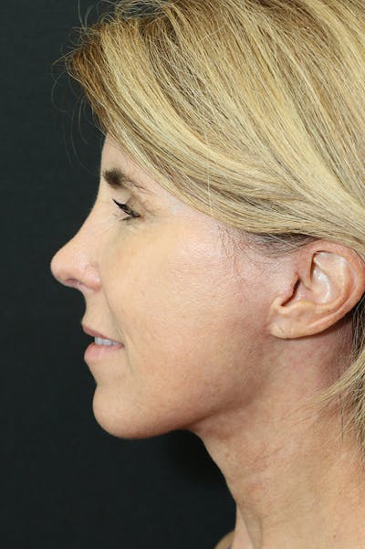 Facelift Before & After Gallery - Patient 24311071 - Image 4