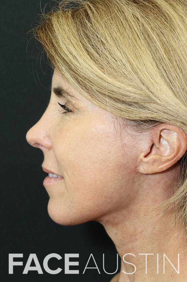 Facelift Before & After Gallery - Patient 24311071 - Image 4