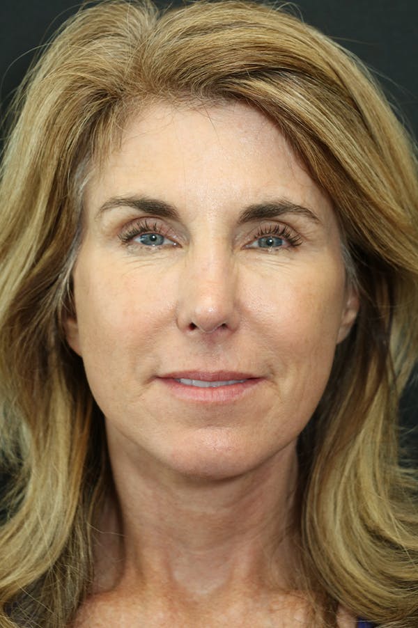 Facelift Before & After Gallery - Patient 24311071 - Image 6