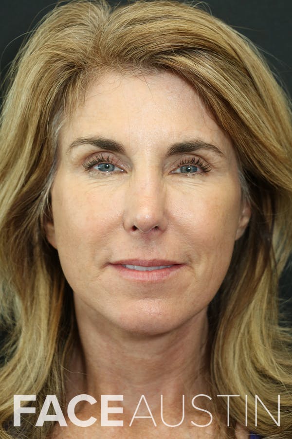 Facelift Before & After Gallery - Patient 24311071 - Image 6