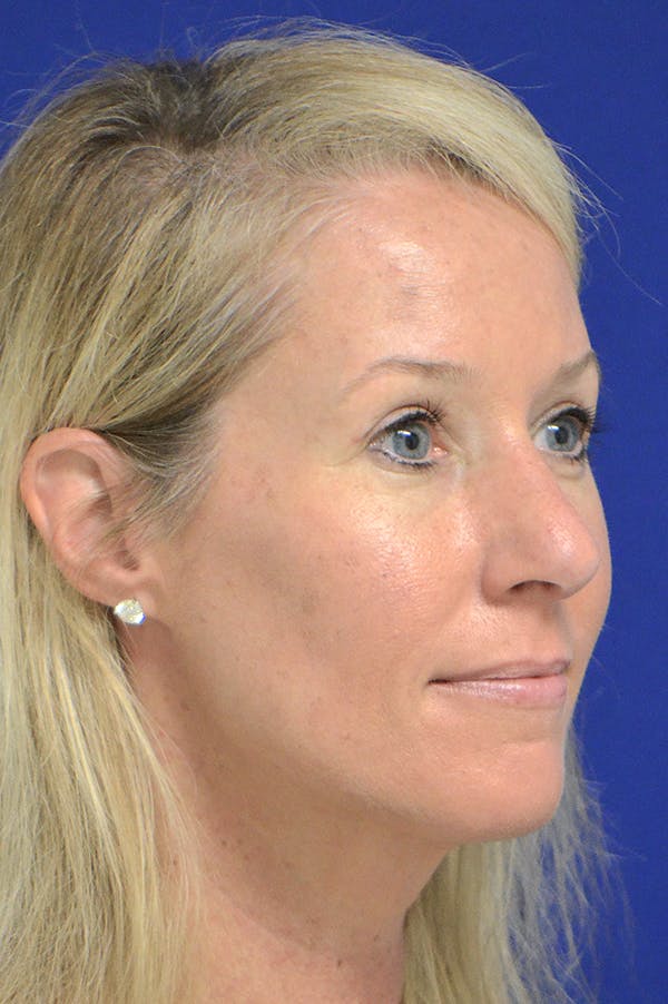 Rhinoplasty Before & After Gallery - Patient 18726389 - Image 2