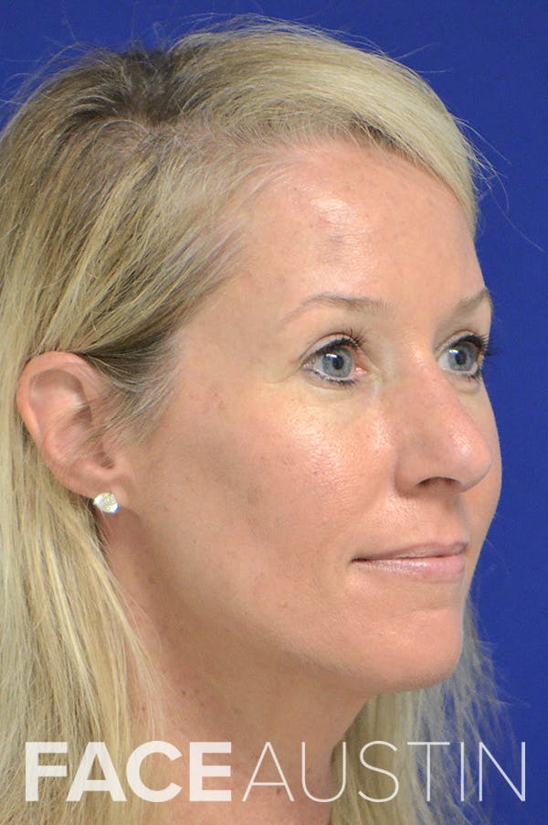 Rhinoplasty Before & After Gallery - Patient 18726389 - Image 2