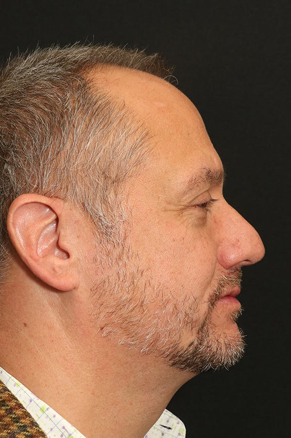 Rhinoplasty Before & After Gallery - Patient 26211149 - Image 1