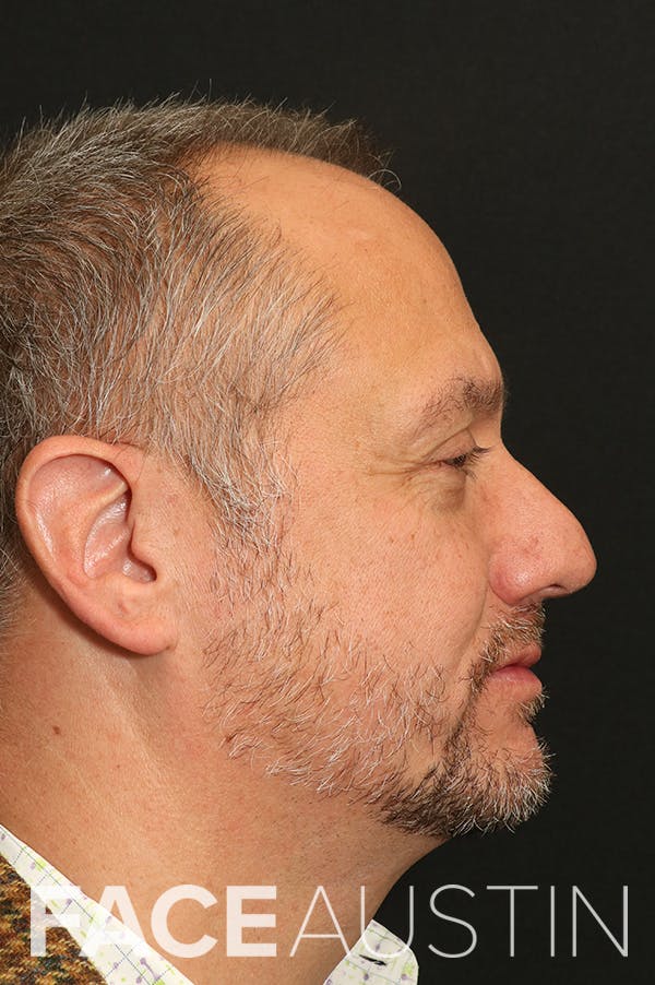 Rhinoplasty Before & After Gallery - Patient 26211149 - Image 1