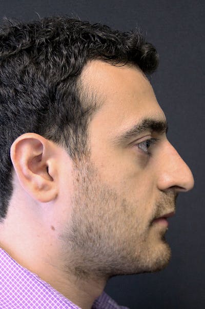 Rhinoplasty Before & After Gallery - Patient 26211150 - Image 1