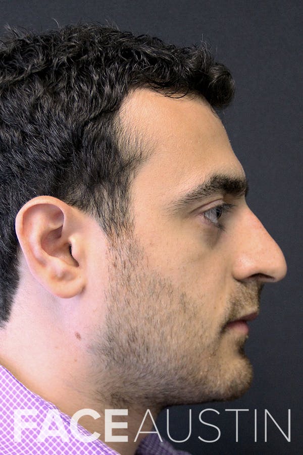 Rhinoplasty Before & After Gallery - Patient 26211150 - Image 1