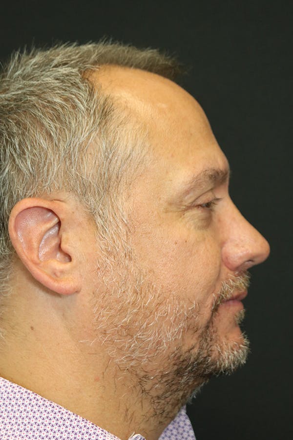 Rhinoplasty Before & After Gallery - Patient 26211149 - Image 2