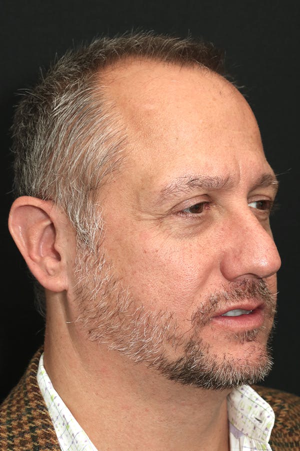 Rhinoplasty Before & After Gallery - Patient 26211149 - Image 3