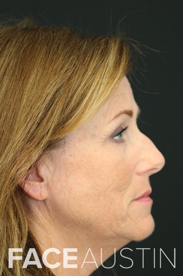Rhinoplasty Before & After Gallery - Patient 26211151 - Image 1