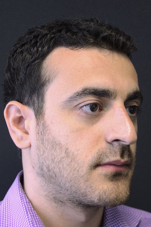 Rhinoplasty Before & After Gallery - Patient 26211150 - Image 3