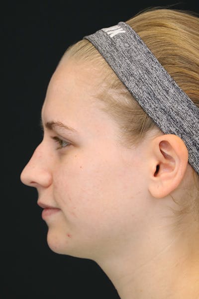 Rhinoplasty Before & After Gallery - Patient 26211152 - Image 1