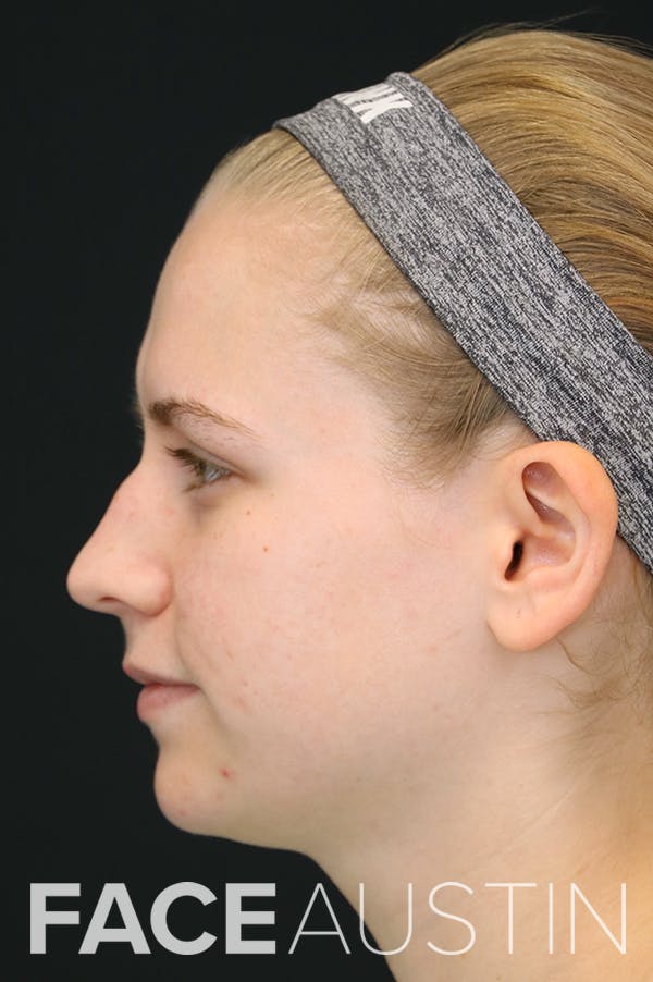 Rhinoplasty Before & After Gallery - Patient 26211152 - Image 1