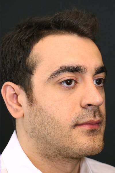 Rhinoplasty Before & After Gallery - Patient 26211150 - Image 4