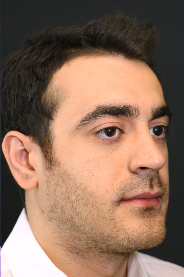 Rhinoplasty Before & After Gallery - Patient 26211150 - Image 4