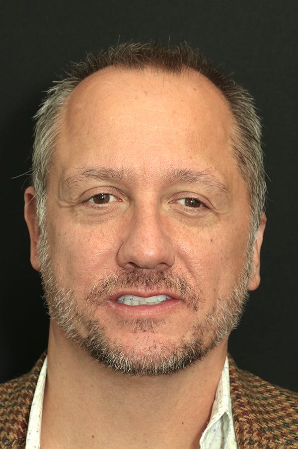 Rhinoplasty Before & After Gallery - Patient 26211149 - Image 5