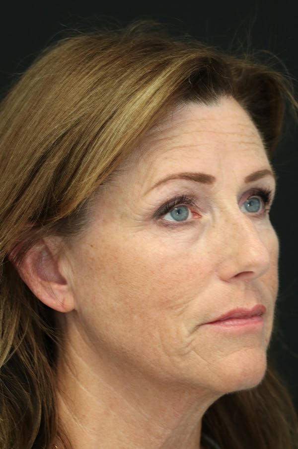 Rhinoplasty Before & After Gallery - Patient 26211151 - Image 3