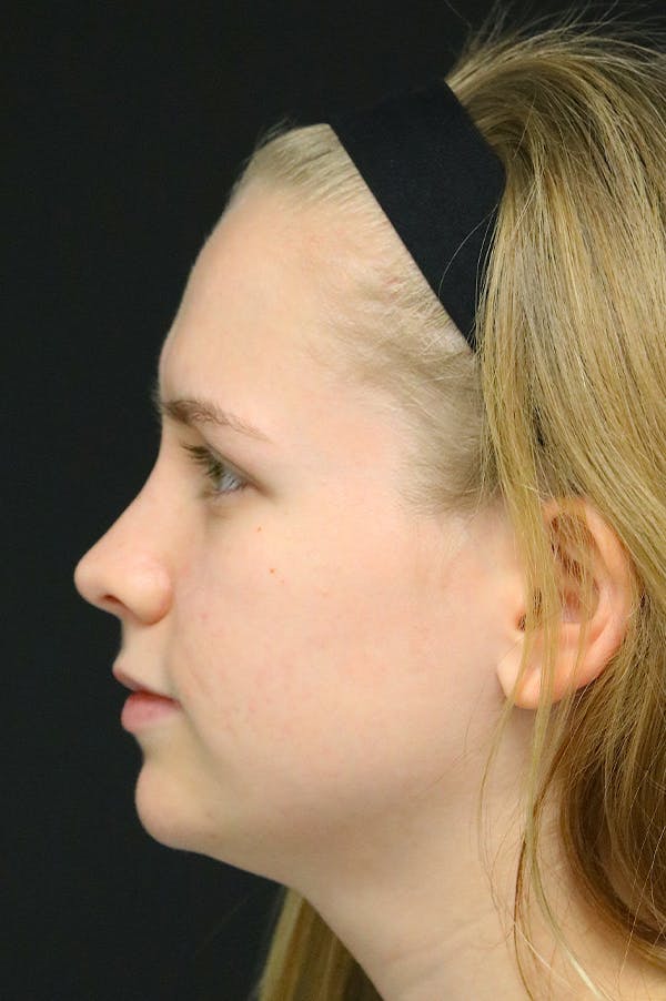 Rhinoplasty Before & After Gallery - Patient 26211152 - Image 2