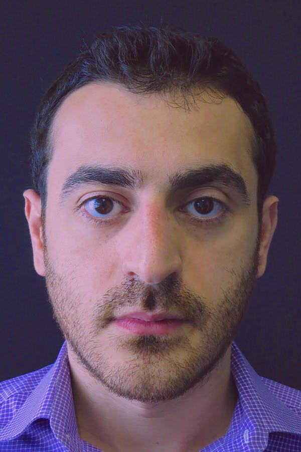 Rhinoplasty Before & After Gallery - Patient 26211150 - Image 5