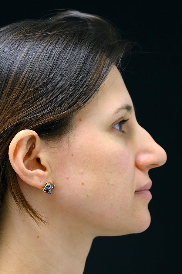 Rhinoplasty Before & After Gallery - Patient 26211153 - Image 1