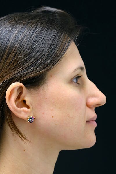 Rhinoplasty Before & After Gallery - Patient 26211153 - Image 1