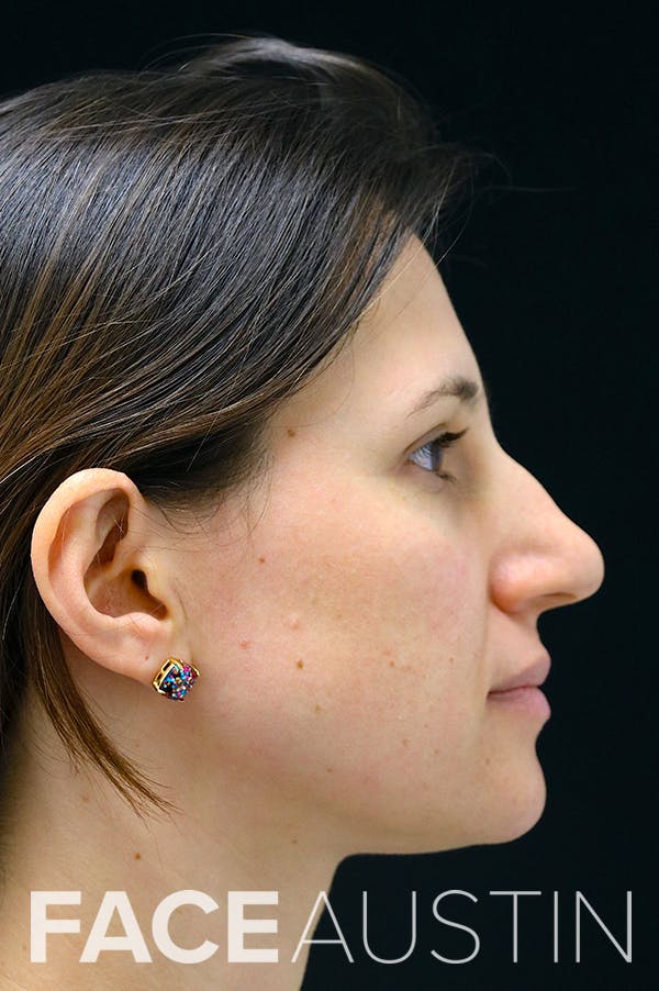 Rhinoplasty Before & After Gallery - Patient 26211153 - Image 1