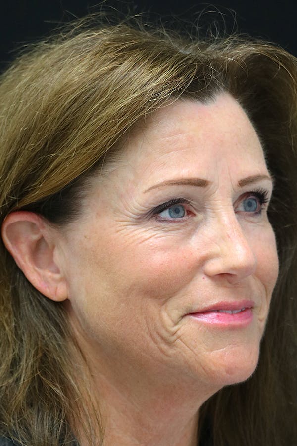 Rhinoplasty Before & After Gallery - Patient 26211151 - Image 4