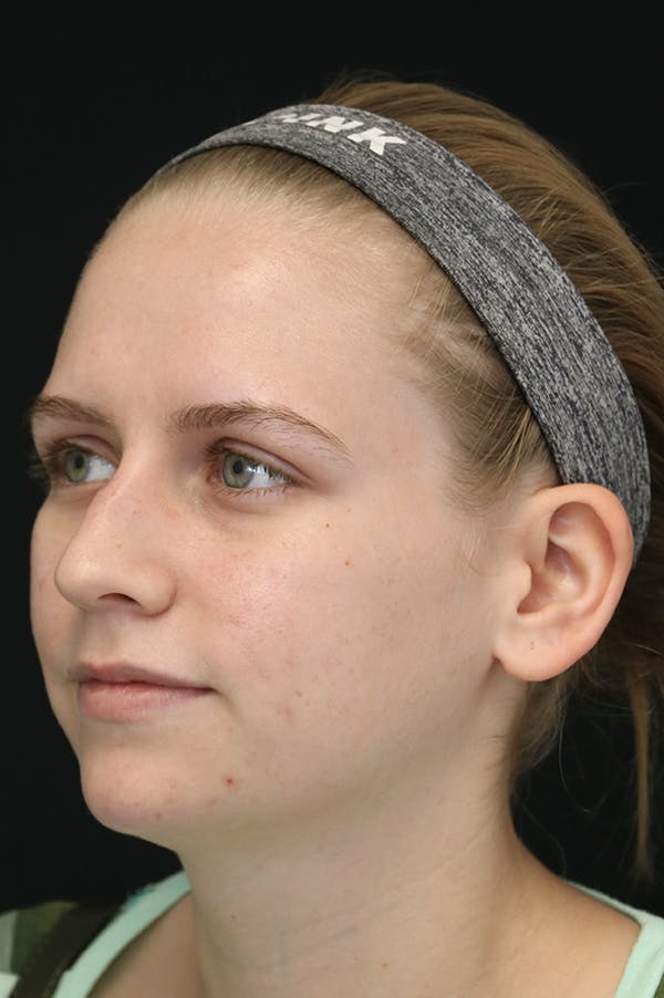 Rhinoplasty Before & After Gallery - Patient 26211152 - Image 3
