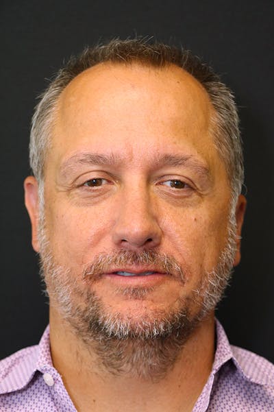 Rhinoplasty Before & After Gallery - Patient 26211149 - Image 6