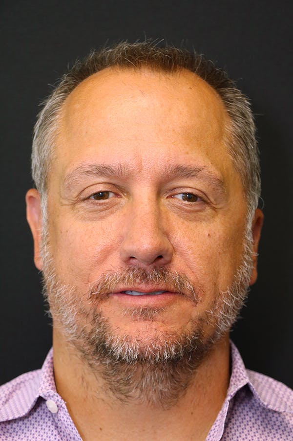 Rhinoplasty Before & After Gallery - Patient 26211149 - Image 6