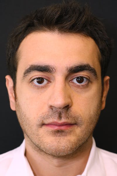 Rhinoplasty Before & After Gallery - Patient 26211150 - Image 6
