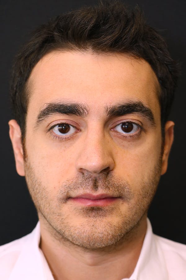 Rhinoplasty Before & After Gallery - Patient 26211150 - Image 6