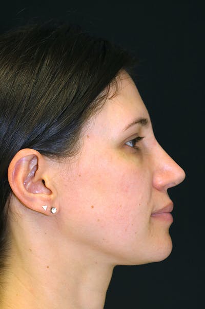 Rhinoplasty Before & After Gallery - Patient 26211153 - Image 2