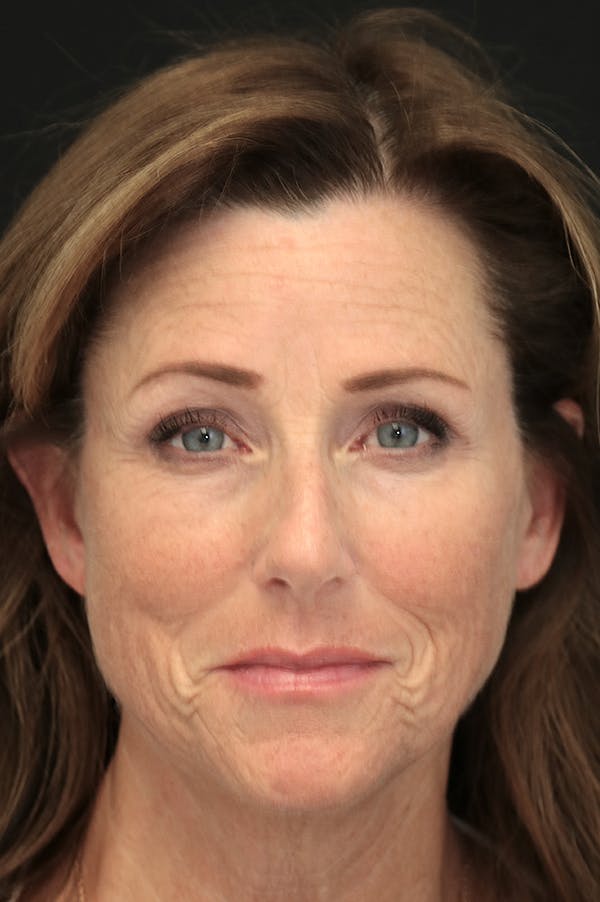 Rhinoplasty Before & After Gallery - Patient 26211151 - Image 5