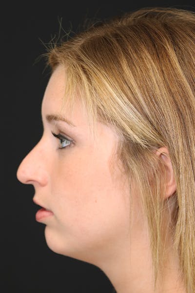 Rhinoplasty Before & After Gallery - Patient 26211154 - Image 1
