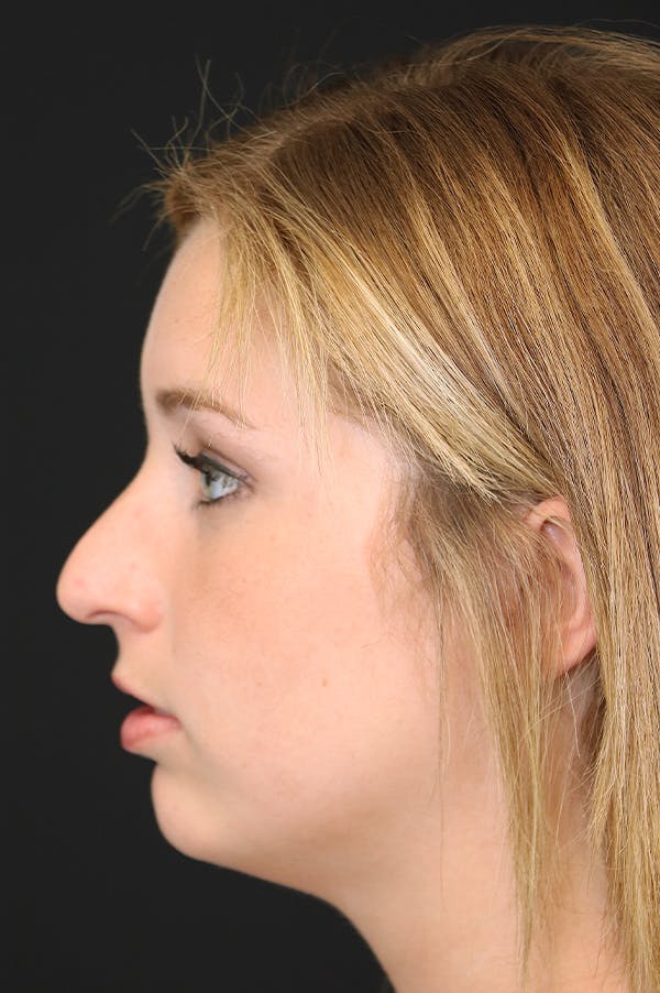 Rhinoplasty Before & After Gallery - Patient 26211154 - Image 1
