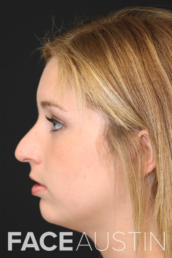 Rhinoplasty Before & After Gallery - Patient 26211154 - Image 1