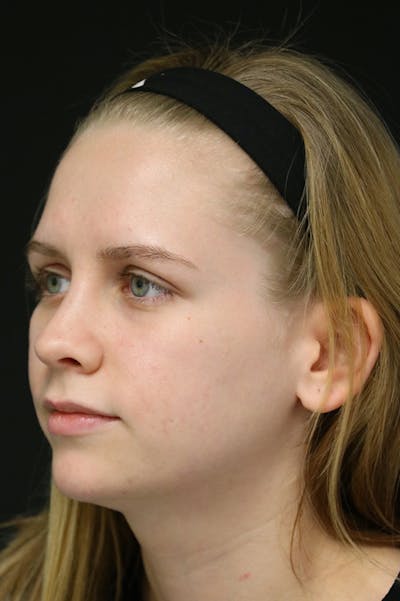 Rhinoplasty Before & After Gallery - Patient 26211152 - Image 4