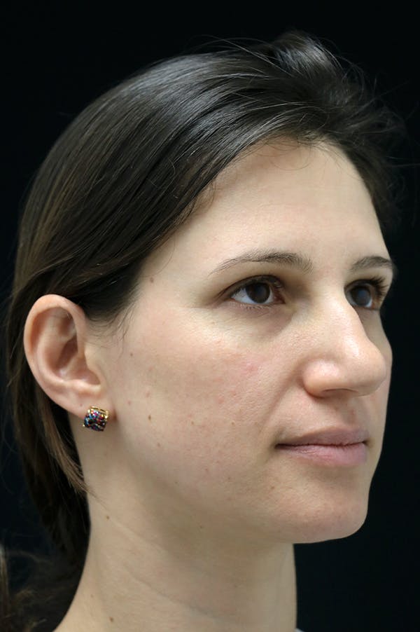 Rhinoplasty Before & After Gallery - Patient 26211153 - Image 3