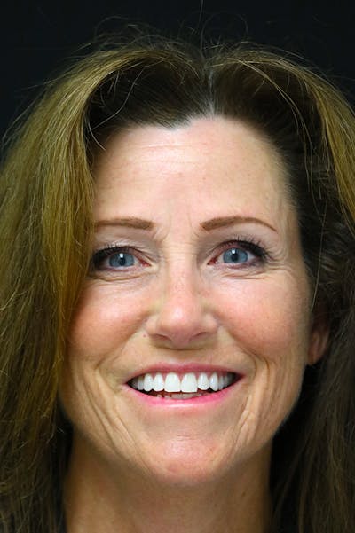 Rhinoplasty Before & After Gallery - Patient 26211151 - Image 6