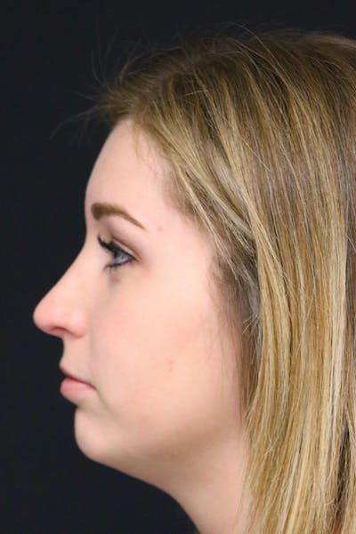 Rhinoplasty Before & After Gallery - Patient 26211154 - Image 2