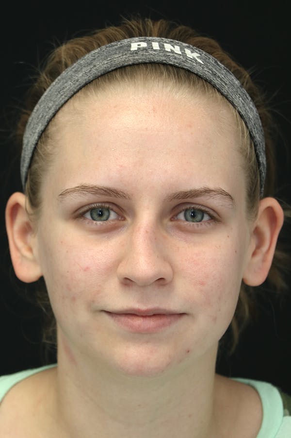 Rhinoplasty Before & After Gallery - Patient 26211152 - Image 5