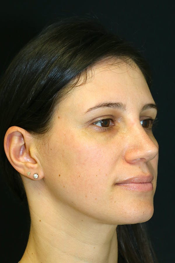 Rhinoplasty Before & After Gallery - Patient 26211153 - Image 4