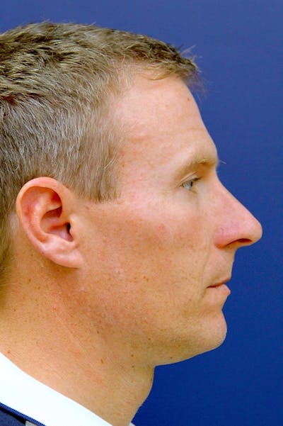 Rhinoplasty Before & After Gallery - Patient 26211155 - Image 1
