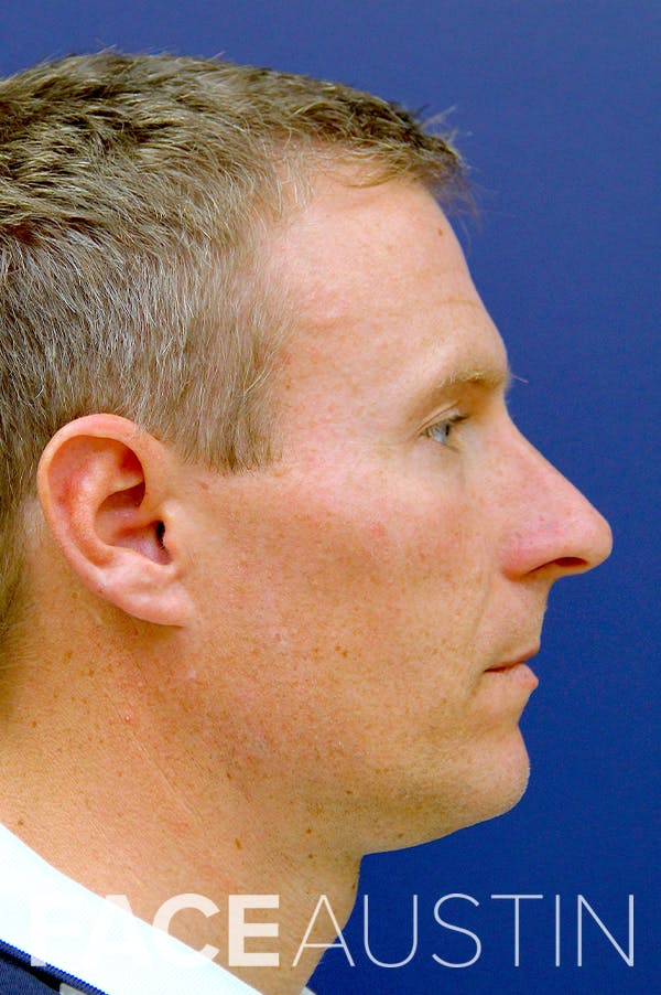 Rhinoplasty Before & After Gallery - Patient 26211155 - Image 1