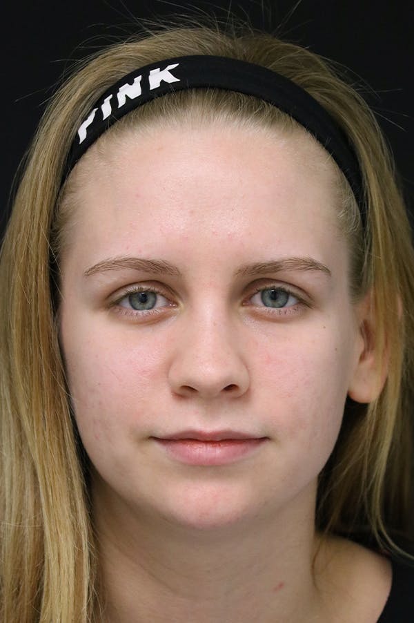Rhinoplasty Before & After Gallery - Patient 26211152 - Image 6