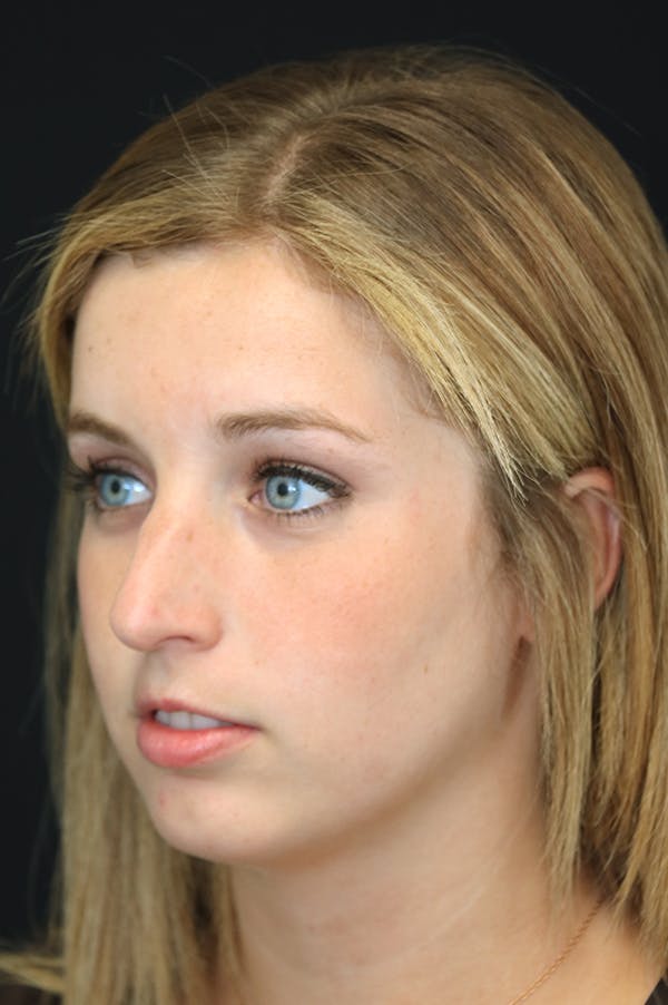 Rhinoplasty Before & After Gallery - Patient 26211154 - Image 3