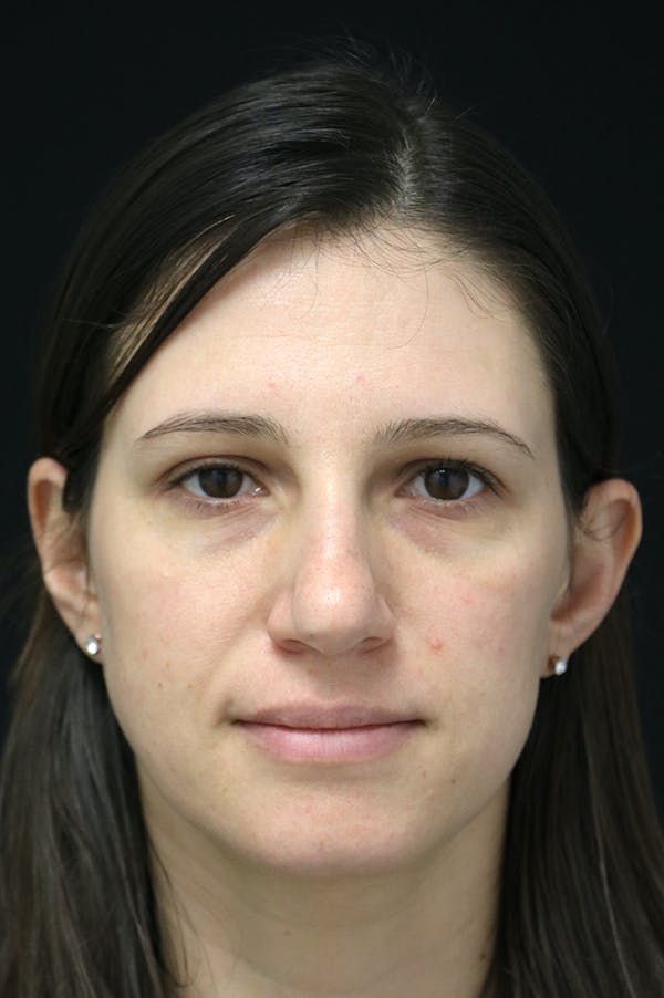 Rhinoplasty Before & After Gallery - Patient 26211153 - Image 5