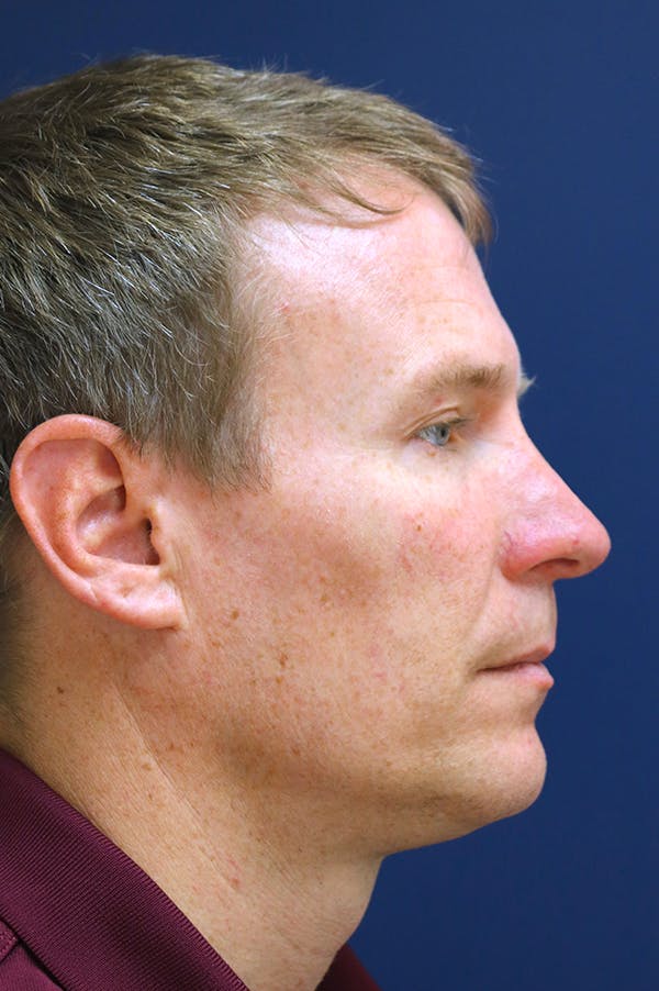 Rhinoplasty Before & After Gallery - Patient 26211155 - Image 2