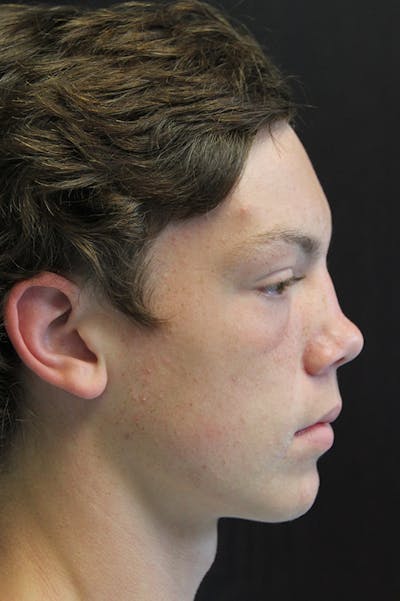 Rhinoplasty Before & After Gallery - Patient 26211156 - Image 1